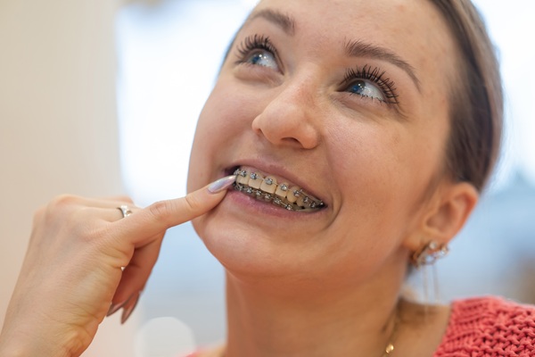What To Know Before Getting Damon Braces